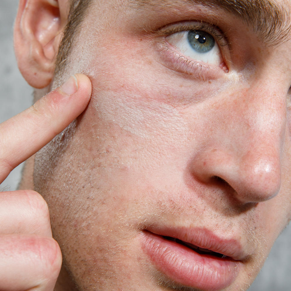 Close-up of man with fair skin, blue eye, and slight facial stubble touching dry, flaking skin on cheek, skincare concept